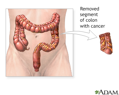 Stage 0 colon cancer